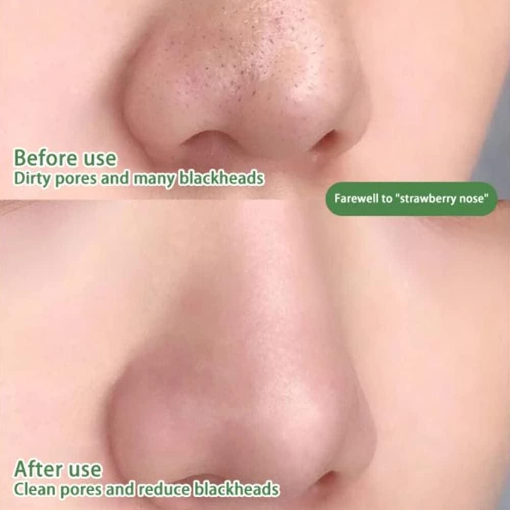 Mască pentru Curățarea Porilor și Controlul Acneei 1+1 Gratuit